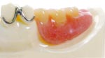 水野歯科クリニック　入れ歯　従来の部分入れ歯01